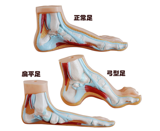 正常足、扁平足、弓型足模型